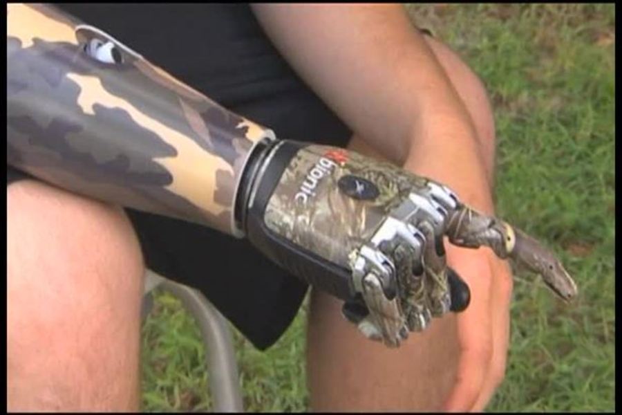 Transforming Lives with Prosthetics : Show Me Science