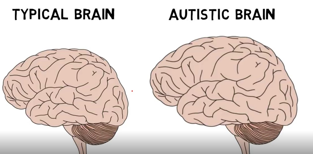 Autism.