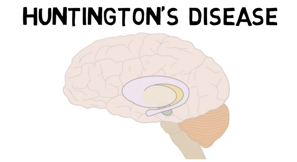 Huntington's Disease.